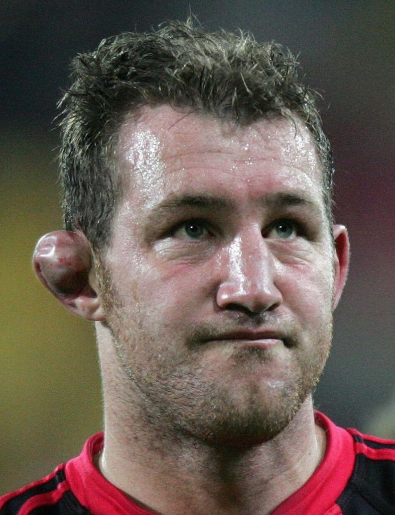 cauliflower ears rugby Chris Jack